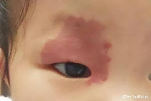 3 hành vi khi mang thai có thể gây ra vết bớt cho con, mẹ cố gắng tránh để con khỏi mặc cảm - Ảnh 1